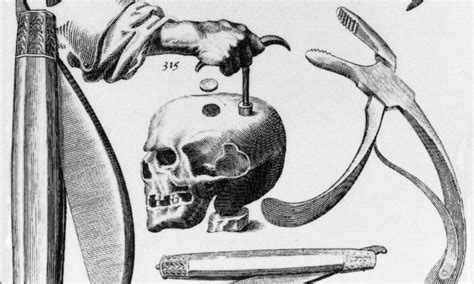 A Hole in the Head: A Complete History of Trepanation | History ...