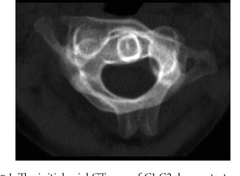 Figure 1 From Case Report Of A Traumatic Atlantoaxial Rotatory