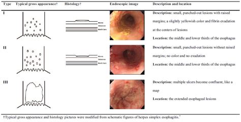 Endoscopia en Esofagitis Infecciosa Gastro Mérida