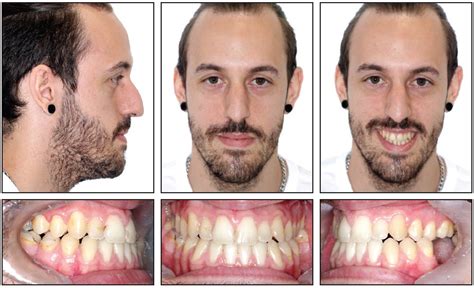 Carriere Nonsurgical Class Iii Open Bite Correction From Jco