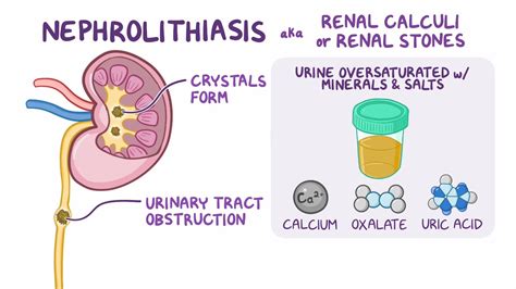 Nephrolithiasis Clinical Sciences Biblioteca De Osmosis