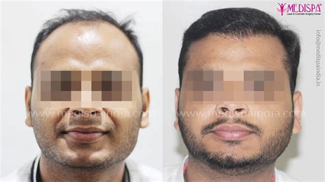 Top 5 Hair Transplant Surgeons In India