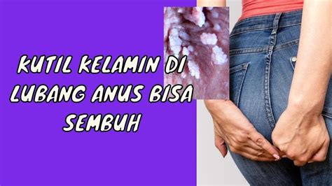 Apakah Kutil Kelamin Di Lubang Anus Bisa Sembuh Dengan Sendirinya