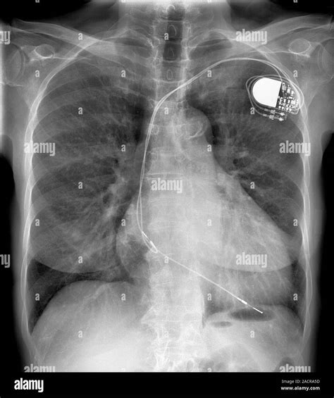 Enlarged Heart X Ray Of The Chest Of A Patient With An Enlarged Heart