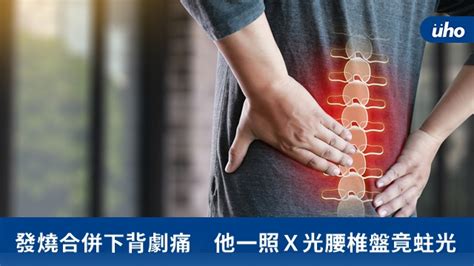 發燒合併下背劇痛 他一照x光腰椎盤竟蛀光uho優活健康網