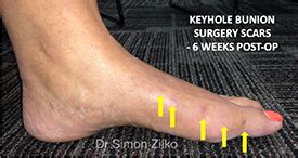 Minimally Invasive Bunion Surgery Perth Dr Simon Zilko St Mtp