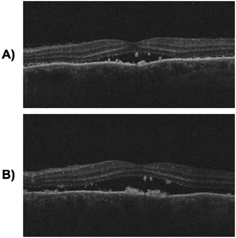 Pachychoroid Findings In A Case Of Uveal Effusion Syndrome Canadian