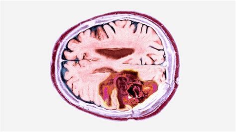 Glioblastoma Signs and Symptoms | Everyday Health