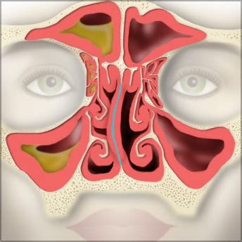 7 Symptoms of a Deviated Septum & How Surgery Might Help