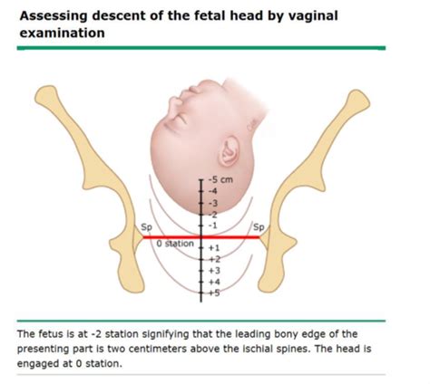 Repro Labor And Delivery Flashcards Quizlet