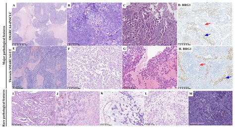 Thoracic Smarca4 Deficient Tumors A Clinicopathological Analysis Of 52 Cases With Smarca4