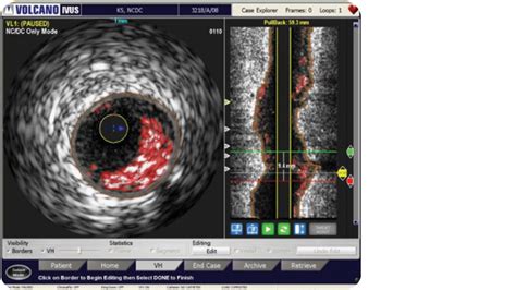 Vh Ivus Philips Healthcare