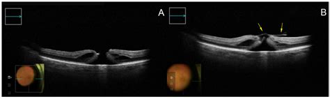 Biomedicines Free Full Text Intraoperative Optical Coherence Tomography In The Management Of