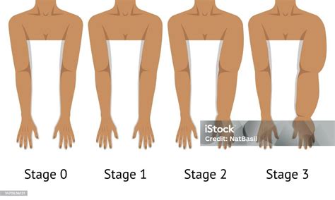 Womens Arms In Different Stages Of Lymphedema Stock Illustration