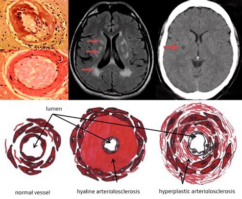 Lacunar stroke | STROKE MANUAL