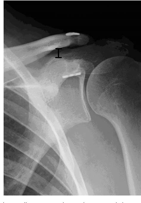 Acromioclavicular Joint Dislocation Semantic Scholar