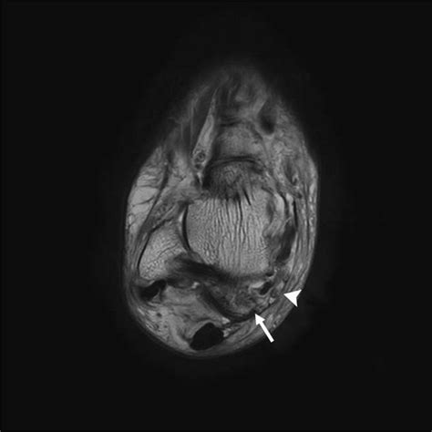 Preoperative Axial T1 Weighted Magnetic Resonance Image Of The Right