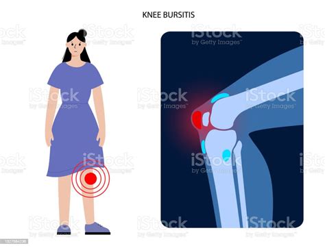 Ilustración de Concepto De Inflamación De La Bursitis y más Vectores