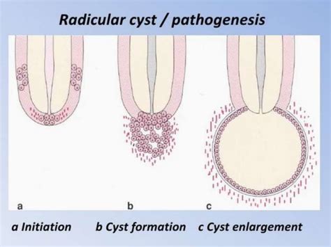 Radicular Cyst