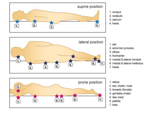 Pressure Ulcer Sites Diagram