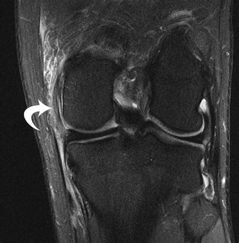 Posteromedial Corner Of The Knee The Neglected Corner Radiographics