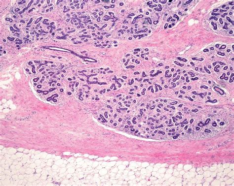 Adenosis Of Human Breast Photograph By Jose Calvo Science Photo Library