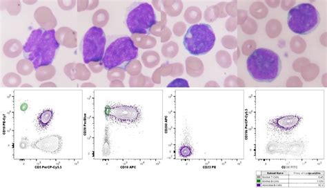 Cd10 Positive Blastoid Variant Of Mantle Cell Lymphoma