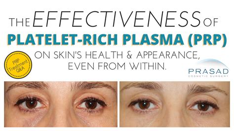 Effectiveness Of Platelet Rich Plasma Prp For Skin And Facial