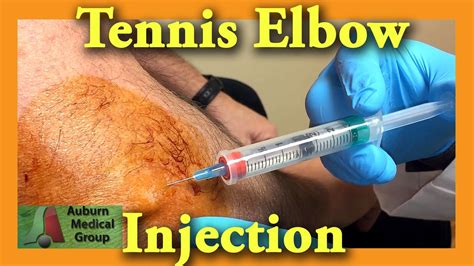 Tennis Elbow Cortisone Injection Auburn Medical Group Youtube