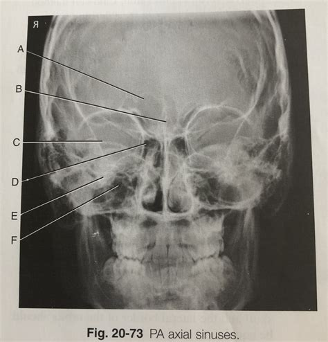 Pa Axial Sinuses Diagram Quizlet