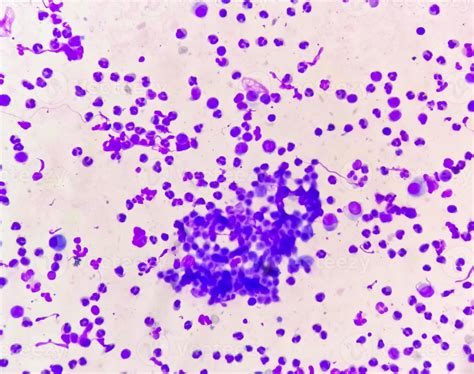 Synovial Fluid Cytology Plenty Wbc Microscopic Examination Of