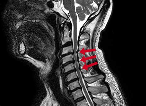 Cervical spinal stenosis - Conditions - Dr. Schröder