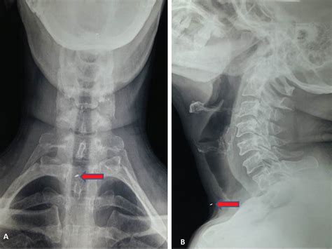 Smallest Missed Foreign Body In Neck A Case Report