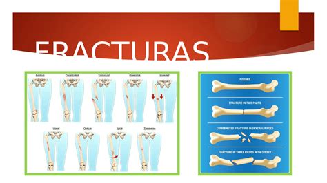 Clasificación De Fracturas Docsity