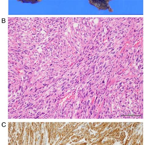 Surgical Specimen A Gross Appearance The Cut Surface Of The Tumor