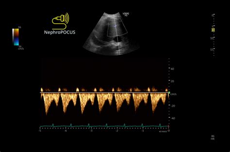 NephroPOCUS On Twitter Rajiv Sinanan Yes That S Why I Put This Up