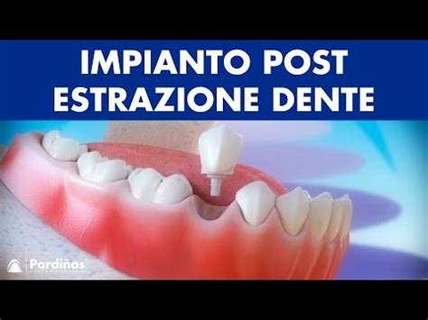 Impianto Dentale Immediato Post Estrazione Dente Youtube