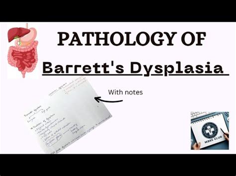 Barrett S Dysplasia Pathology Features Of Barrett S Dysplasia