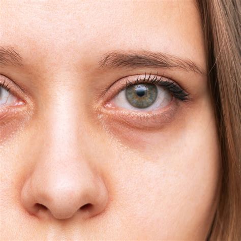 Iron Deficiency Anemia Eyes