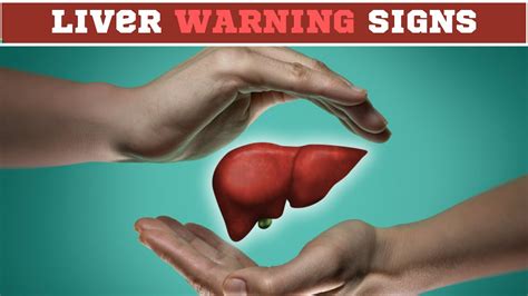 Fatty Liver Symptoms Early Signs Of Fatty Liver Disease Non Alcoholic Fatty Liver Disease