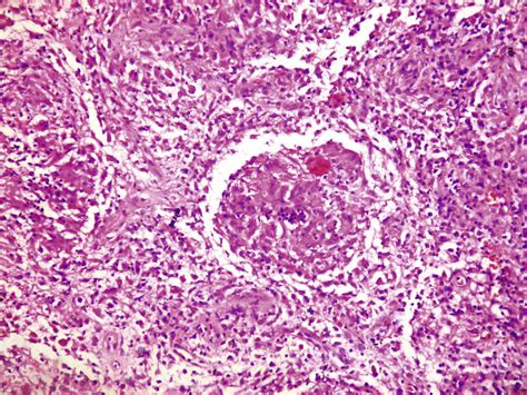 Histopathological Picture Showing Well Formed Granuloma In Centre Download Scientific Diagram