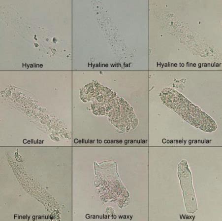 Clinical Biochemistry 5 Urinalysis Flashcards Quizlet