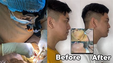 Goodbye Double Chin Submental Lipo And Buccal Fat Removal Full