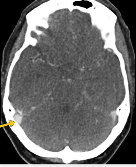 Head CT shows thrombosis of the right transverse dural venous sinus... | Download Scientific Diagram