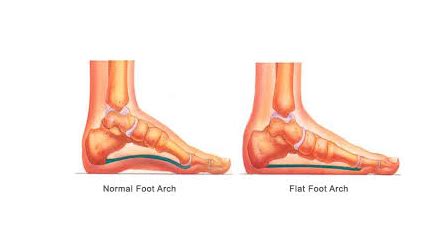 Pronation Distortion Syndrome: All You Need To Know - Daily Medicos