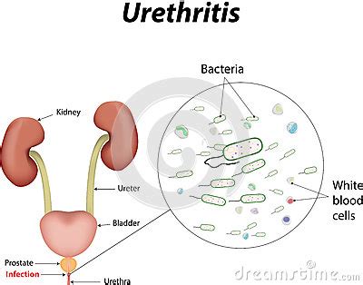 Images - Urethritis