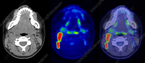 Hodgkin's disease, CT and PET scans - Stock Image - C057/5221 - Science ...