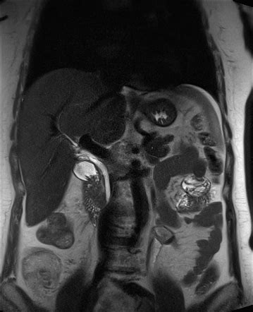 Intraductal Papillary Neoplasm Of The Bile Duct Radiology Case