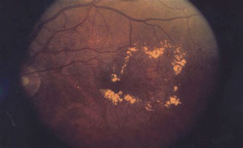 Lucentis Ranibizumab For The Treatment Of Diabetic Macular Edema Dme Clinical Trials Arena