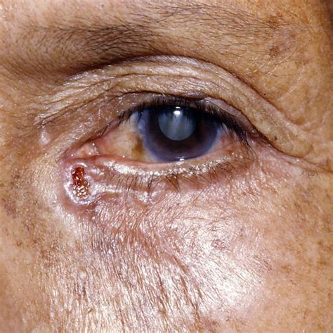 Basal Cell Carcinoma What Is It And How Do You Treat It Salt Lake